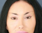 Feel Beautiful - Bratz Blepharoplasty - After Photo